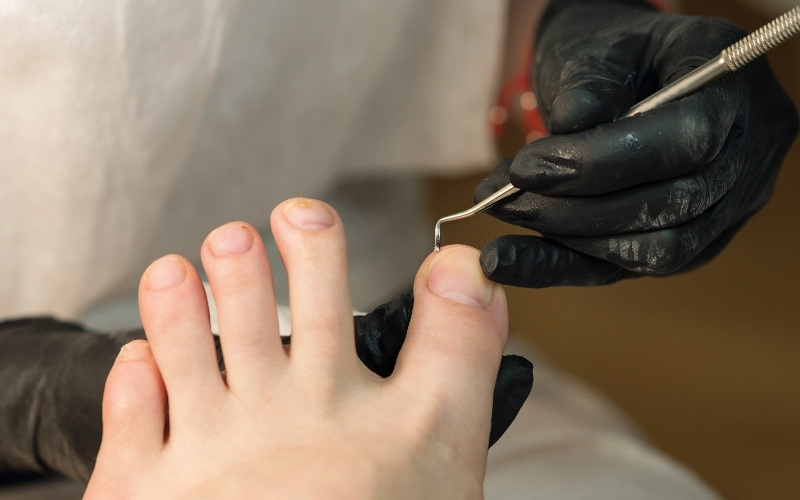 Avoid digging out ingrown toenails